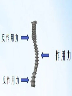 什么是脊柱側(cè)彎矯形器？
