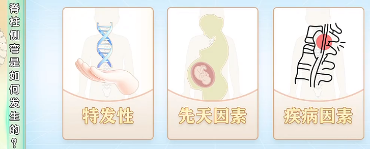 脊柱側彎是如何發(fā)生的