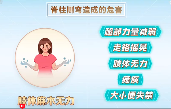 脊柱側彎造成的危害