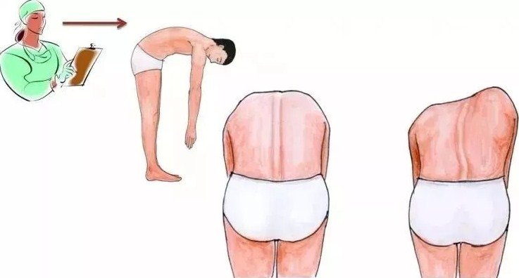 脊柱側(cè)彎早發(fā)現(xiàn)，早治療