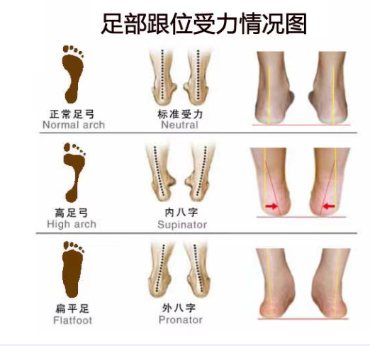 扁平足和脊柱側彎之間有關聯嗎？
